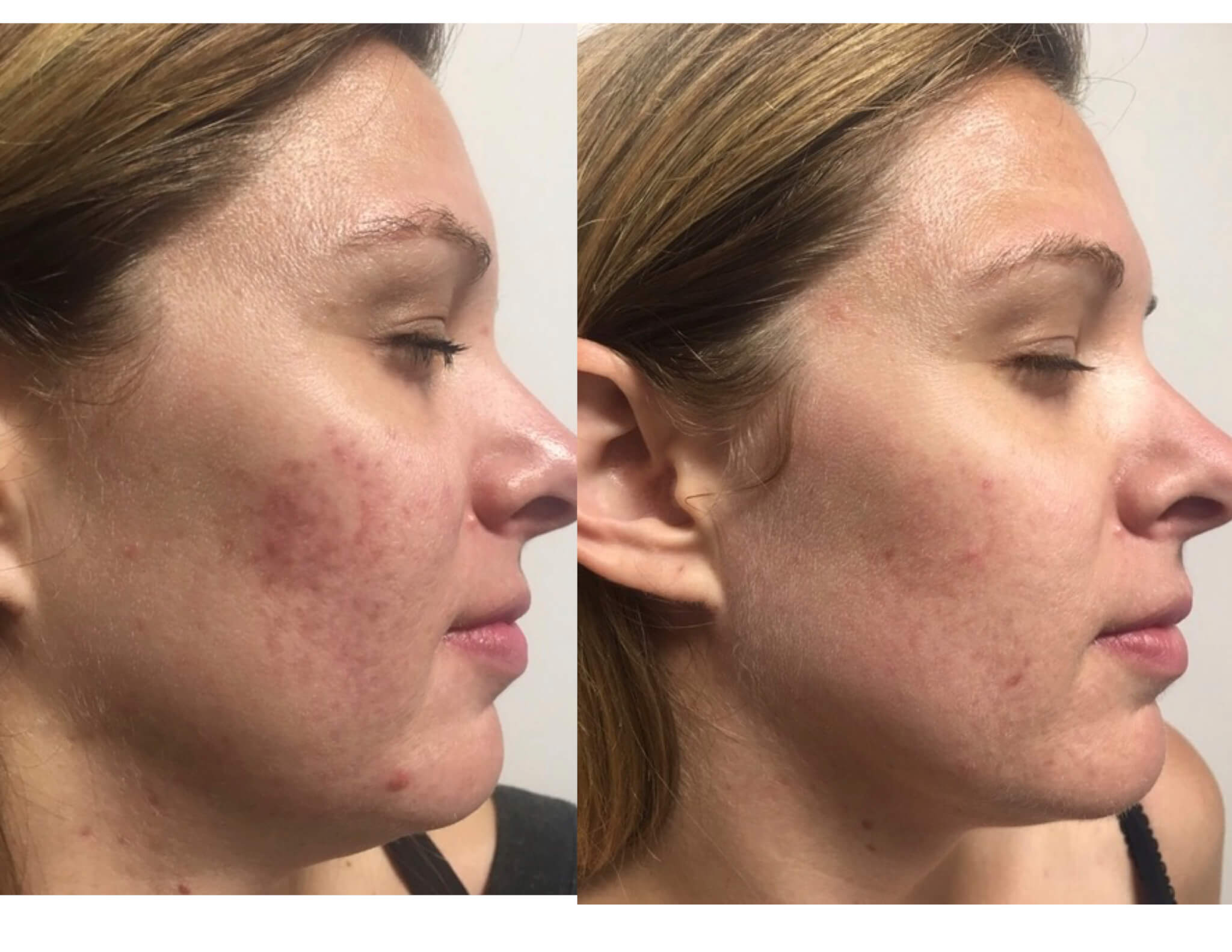 VI Peel Before & After 2 | Grand Salon & MedSpa