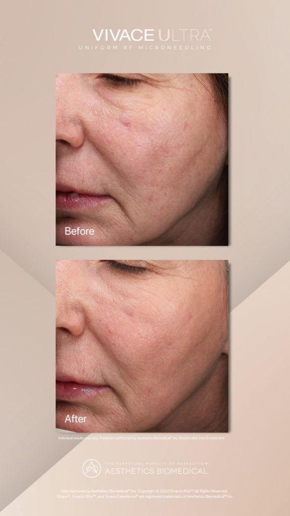 RF Microneedling before and after Grand Salon & MedSpa